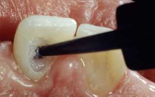 Внутриканальное отбеливание зубов утративших нерв