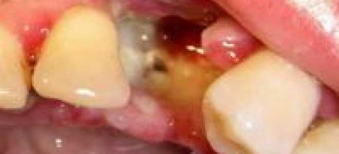 Белый налет в лунке после удаления зуба