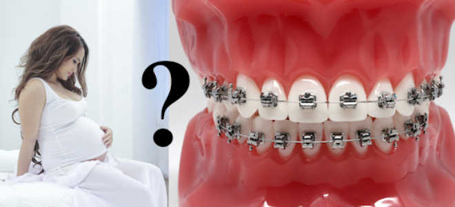 Брекеты во время беременности