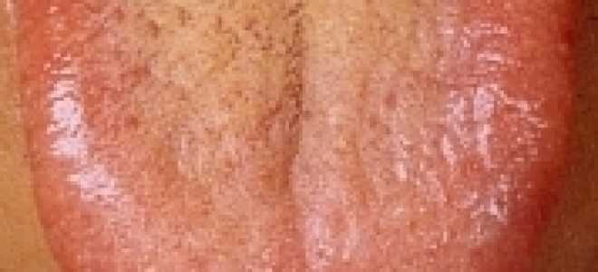 Налет на языке и горечь во рту