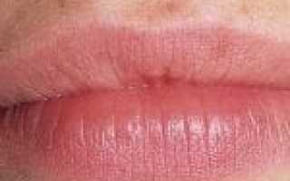 Как лечить заеду в уголке рта