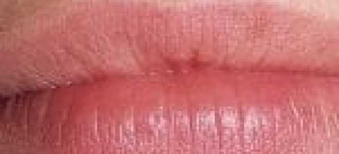 Причины заедов в уголках рта