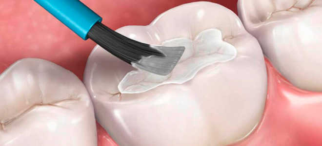 Что такое герметизация фиссур