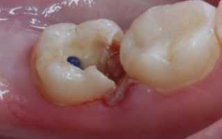 Зачем кладут мышьяк в зуб