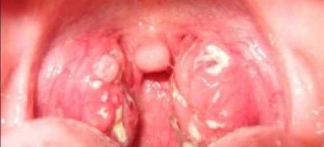 Как лечить пробки в гландах