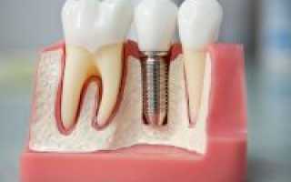 Виды имплантации зубов плюсы и минусы