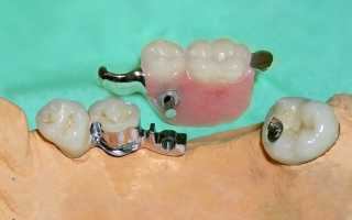 Съемный протез на один зуб