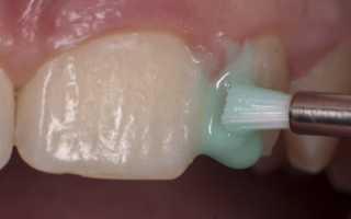 Как очистить зубы от кариеса