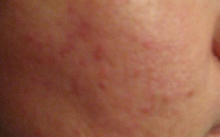 Аллергия на зубную анестезию