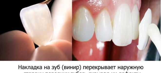 Керамические накладки на зубы