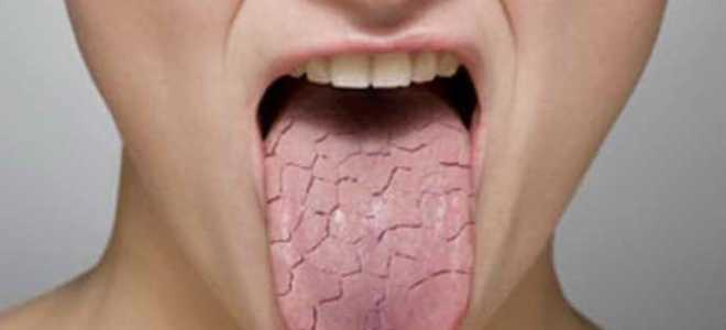 Складчатый глоссит врожденный