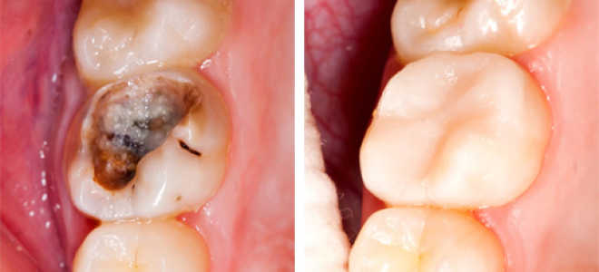 Кариес во время беременности