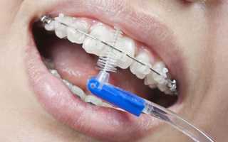 Как чистить зубы с брекетами