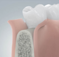 Имплантация зубов без костной пластики