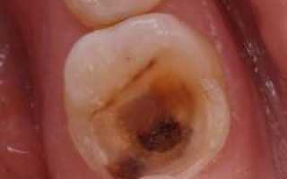 Воспаление корня зуба
