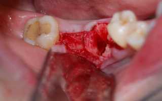 Сколько зубов за один раз можно удалить
