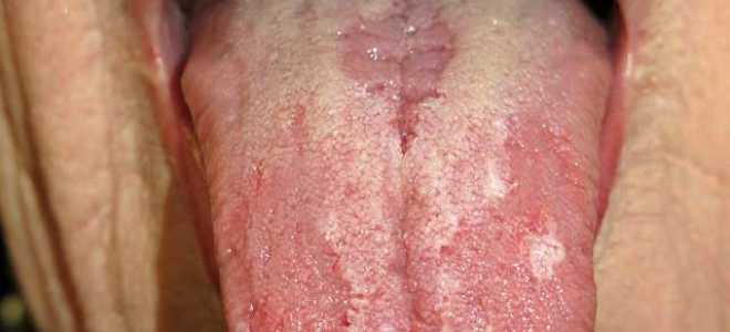 Чем лечить глоссит на языке у взрослых