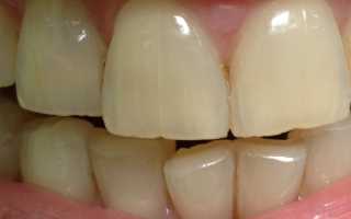 Трещины на зубной эмали