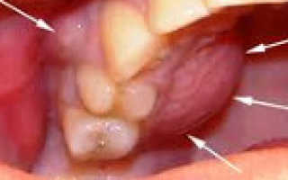 Воспаление надкостницы челюсти лечение
