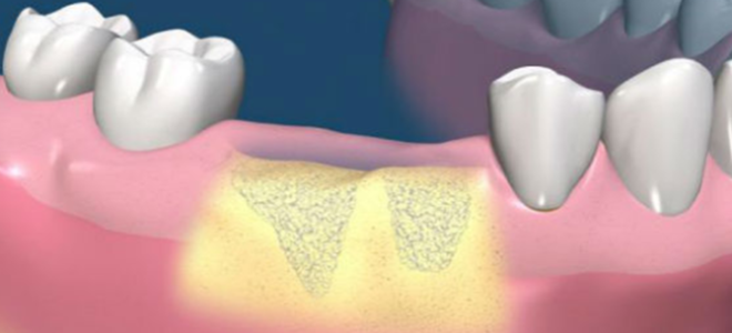 Наращивание костной ткани перед имплантацией зубов