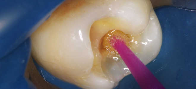 Что такое адгезивный