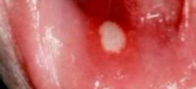 Белая болячка во рту
