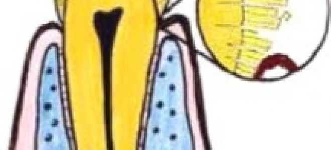 Некариозные поражения зубов возникающие после прорезывания