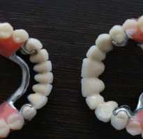 Протезирование зубов бюгельными протезами
