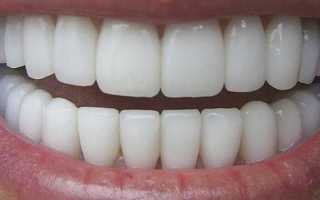 Отбеливание зубов с помощью перекиси водорода