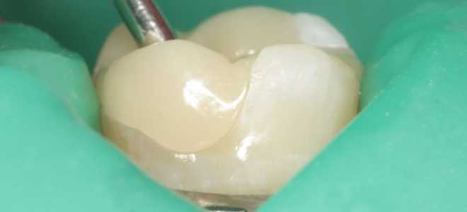 Временная пломба на зуб