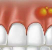 Гной из десны около зуба лечение