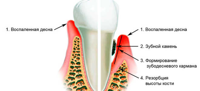 Почему воспаляются десна