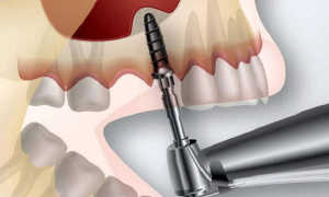 Синуслифтинг при имплантации зубов
