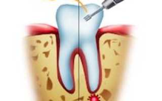 Удаление кисты корня зуба