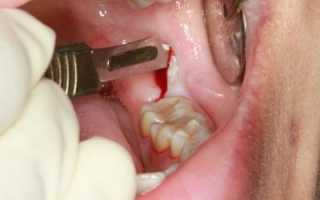 Осложнения после удаления зуба мудрости нижняя челюсть