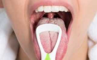 Лечение кандидоза полости рта у взрослых и детей