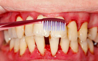 Кровоточат десны при чистке зубов лечение