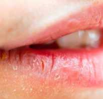 Чем лечить хейлит на губах
