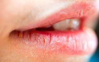 Воспаление каймы губ