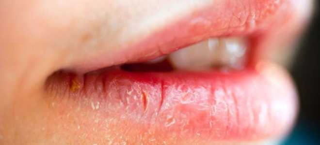 Воспаление каймы губ