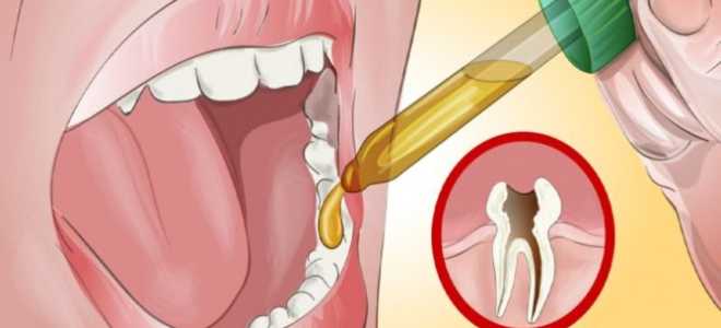 Как вылечить зубную боль в домашних условиях быстро