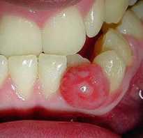 Удаление зуба с кистой последствия