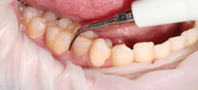 Снятие зубных отложений ультразвуком