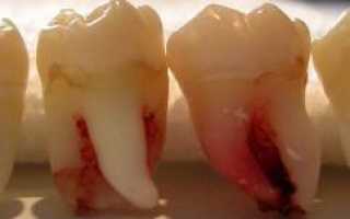 Больно ли удалять коренной зуб