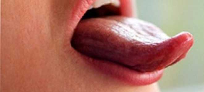 Как лечить типун на языке в домашних условиях