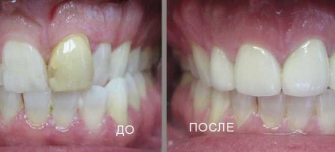 Коронки на передние зубы