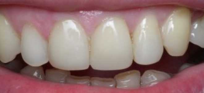 Художественная реставрация зубов