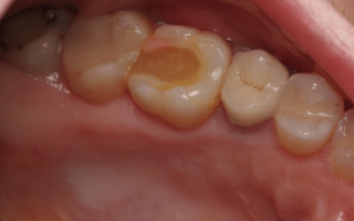 Почему выпадает пломба из зуба