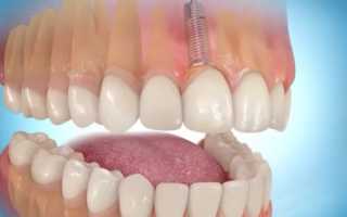 Сколько стоит вставить один имплантат зуба