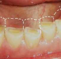Патологическое стирание зубов